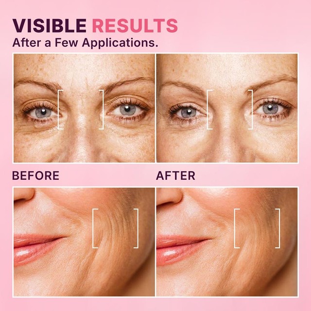 BOTOX---PRIJE-POSLIJE