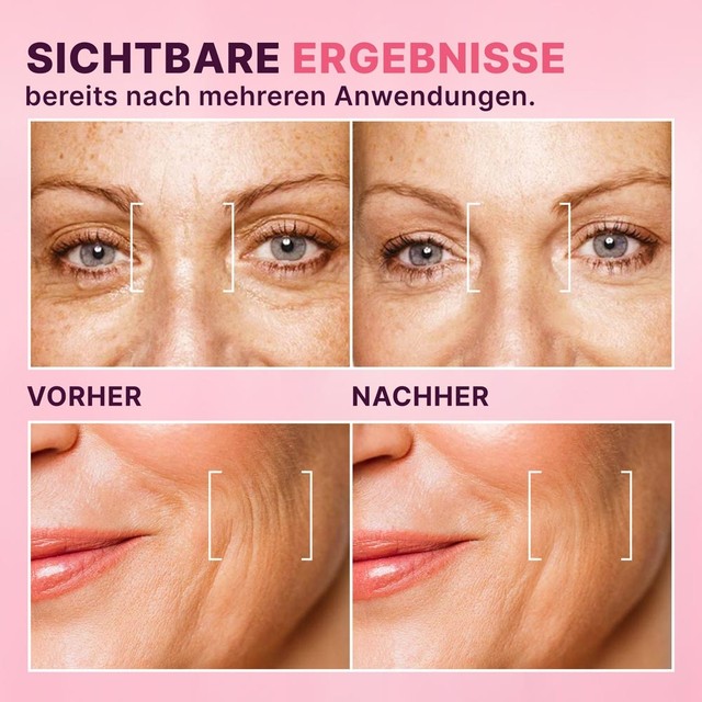 BOTOX---PRIJE-POSLIJE